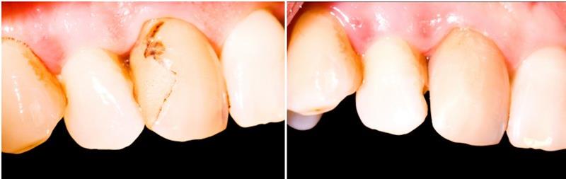 Before and after photos of James T.'s smile after teeth whitening and bonding