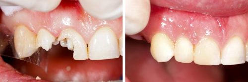 before after-1