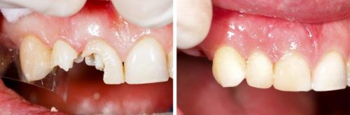 before after-11