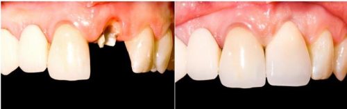 before after-12