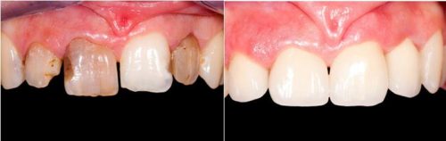 before after-14