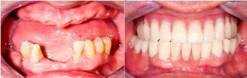 before after-15